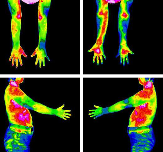 Carpal Tunnel Syndrome