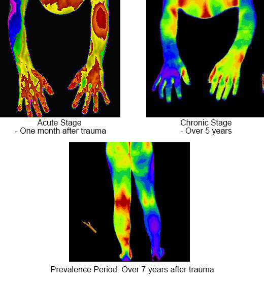 Complex Reginal Pain