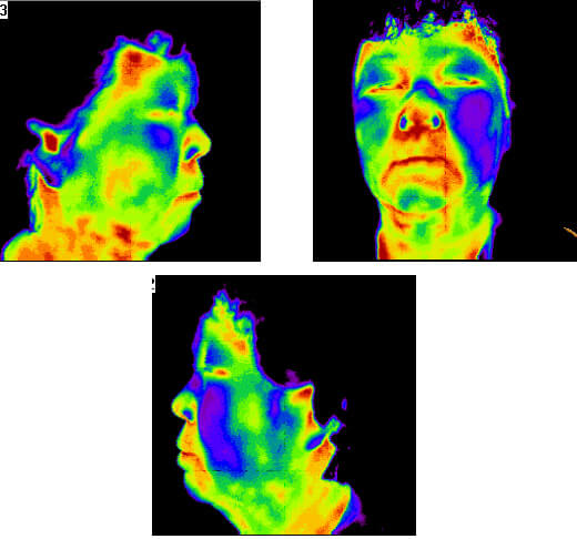 Facial Palsy